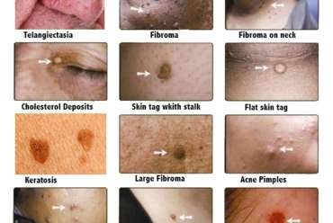 Skin Lesion Removal